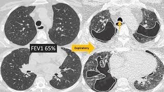 Understanding Bronchiolitis [upl. by Hadsall]