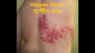 Herpes Zoster হার্পীশ নাবা [upl. by Nwahsd]