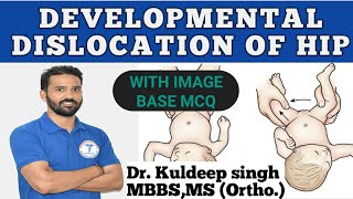 DDHDevlopmental Dislocation Of the Hip By Dr Kuldeep singh [upl. by Hartill]