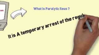 What Is Paralytic Ileus and Ways Of Ileus Treatment [upl. by Keare485]