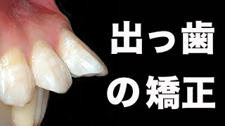 出っ歯 buck teeth GVBDO Before amp After Braces Time Lapse 410 Days 醜い容貌と顎関節症 TMDを治し完全復活した歯列矯正 [upl. by Dajma60]