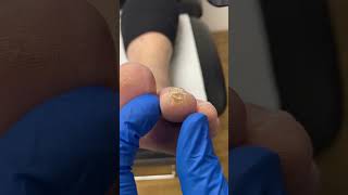 Unleash the secrets of toe callus removal by a podiatrist Your feet deserve the best [upl. by Castera]