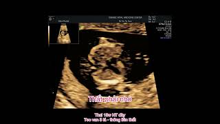 Siêu âm tim thai 13 tuần teo van 3 lá  thông liên thất TA VSD tricuspid atresia with VSD [upl. by Narruc]