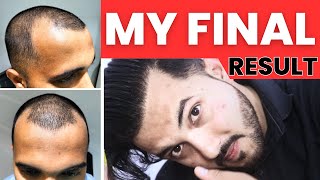 Journey Of My Full Hair Transplant Result After 1 Year  Best Hair Transplant Result In India 2023 [upl. by Sidwell]