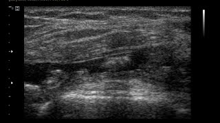 Chronic Synovitis Knee Joint  Effusion Joint  Hypertrophid Synovial [upl. by Ahsiekit]