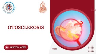 Otosclerosis [upl. by Mercado]