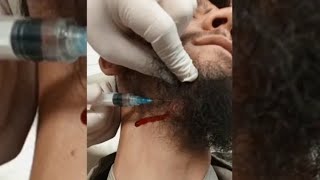 neck abscess Drainage 😱 تخلیه آبسی گردن [upl. by Corabel175]