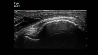 Knee Ultrasound Infrapatellar Bursitis Aspiration Part 3 [upl. by Elana]