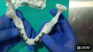 Edentulous Maxilla and Mandible Reconstruction  3D Printed Subperiosteal Implants [upl. by Anoerb]