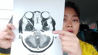 My brain tumor story  sphenoid wing meningioma [upl. by Safier417]