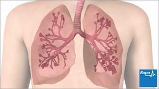 How an asthma attack occurs  Bupa Health [upl. by Vergil]