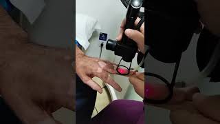 Laser treatment for Vitiligo vitiligo vitiligotreatment laser [upl. by Ramuk]