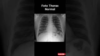 Foto Thorax normal xray radiology chest normal [upl. by Deerdre402]