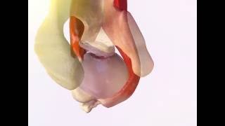 Engaged Hill Sachs lesion [upl. by Menon]