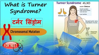 What is Turner Syndrome  Turner’s Syndrome  Principles of Inheritance and Variation  NEET [upl. by Palua]