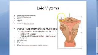 Pathology 721 a Leiomyoma FIBROID uterus fibromyoma Smooth muscle benign Gross specimen Practical [upl. by Alecram]