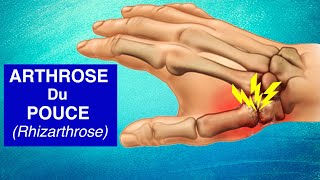 ARTHROSE DU POUCE Rhizarthrose  Explication Diagnostic et Traitements [upl. by Elocon988]