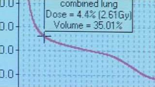 Radiation dose volume histogram 55 [upl. by Ethbinium310]