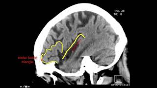 Introduction to Brain Surface Anatomy [upl. by Agnot]