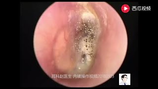 Earwax Removal ExtractionCerumen airtight 13 minutes [upl. by Leiuqeze]