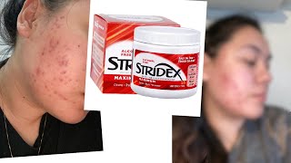 TRYING STRIDEX FOR A WEEK  WEEK 3  MY ACNE JOURNEY [upl. by Burch]