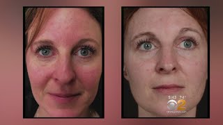 Laser Treatment for Rosacea Part II [upl. by Melinde]