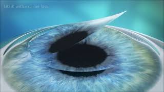 LASIK with excimer laser [upl. by Gladys]