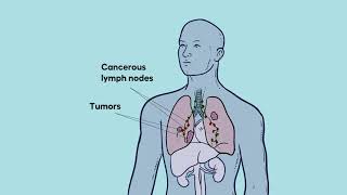 Nonsmall Cell Lung Cancer Explained [upl. by Attelocin]