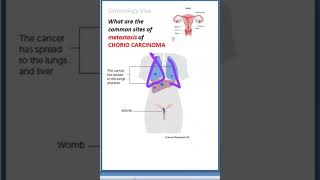 Gynecology 320 ChorioCarcinoma Metastasis Common sites Lung Viva [upl. by Atteyram]