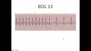 22 EKG atrial flutter vs atrial fibrillation  ការរៀនអាន ECG លើអ្នកជំងឺមាន A Flutter vs A Fib [upl. by Nhoj]