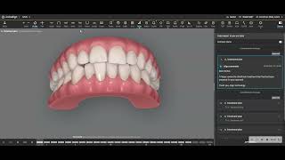 Interproximal Reduction with Invisalign is SAFE if planned properly [upl. by Helga]