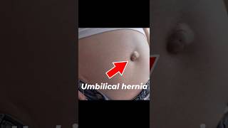 Umbilical hernia I Laparoscopic treatment of Umbilical hernia [upl. by Saretta121]