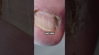 This happens after the SCAB comes off your damaged toenails [upl. by Ginny]