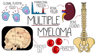 Understanding Multiple Myeloma Multiple Myeloma Explained Clearly [upl. by Gregorio]