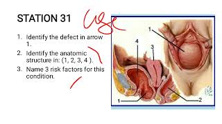 Cystocele Case Study [upl. by Ecirtemed172]