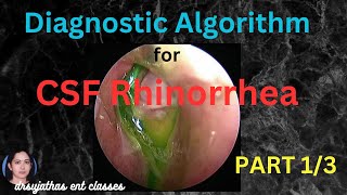 234CSF Rhinorrhea Part 13  Diagnostic Algorithm for Cerebrospinal Fluid Leak surgeryeducation [upl. by Xylia]