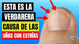 🔴 ¿Porque tengo UÑAS con ESTRÍAS ¡Esta es la verdadera CAUSA Tu cuerpo te HABLA [upl. by Ardrey]