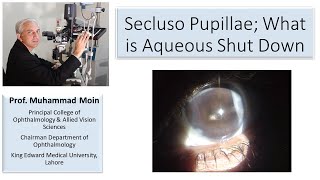 Occluso Pupillae What is Aqueous Shut Down [upl. by Amaral]