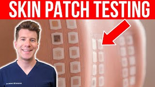 ALLERGY TESTING Doctor explains the Skin Patch Test [upl. by Lyrradal425]