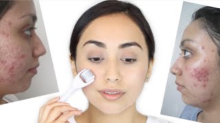 Derma Roller for Acne Scars  How I Healed My Acne Scars [upl. by Niu]