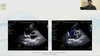 Approach to Congenital Cyanotic Heart Disease in neonatal period  Dr M Venkatesh [upl. by Remas]