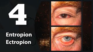 4 Eye lids Entropion amp Ectropion [upl. by Dumas]