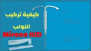 طريقة تركيب اللولب  Mirena IUD [upl. by Ferrigno]