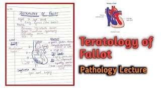 Tetralogy of fallot  Cardiology medical [upl. by Nerak358]