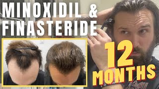 Minoxidil amp Finasteride  12 Month Update  Christopher Painter [upl. by Esmaria799]