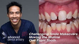 Difficult and Challenging Smile Makeover  One Central Tooth  Moving the Midline [upl. by Ennovihc291]