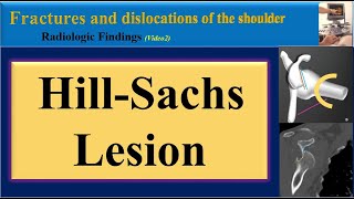 Hill Sachs Lesion [upl. by Annabal]