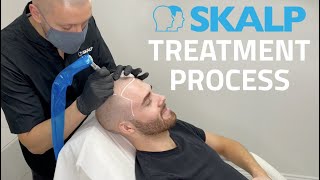 Skalp® Scalp Micropigmentation Treatment Process [upl. by Donelson]