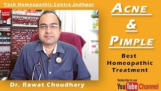 Acne and Pimple Best Homeopathic Treatment  Yash Homeopathic Centre Jodhpur [upl. by Elehcir]