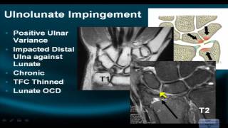 MRI Online Wrist Part VI Evaluating Impingement Syndromes of the Wrist [upl. by Nahshun904]